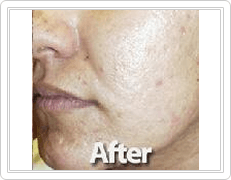 face Acne Treatment after