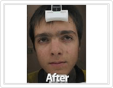 acne treatment for men after