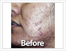 face Acne Treatment before
