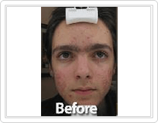 acne treatment for men before