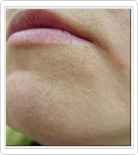 chin hair removal after