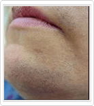 chin hair removal before
