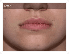 upper lip hair removal after