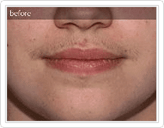 upper lip hair removal before